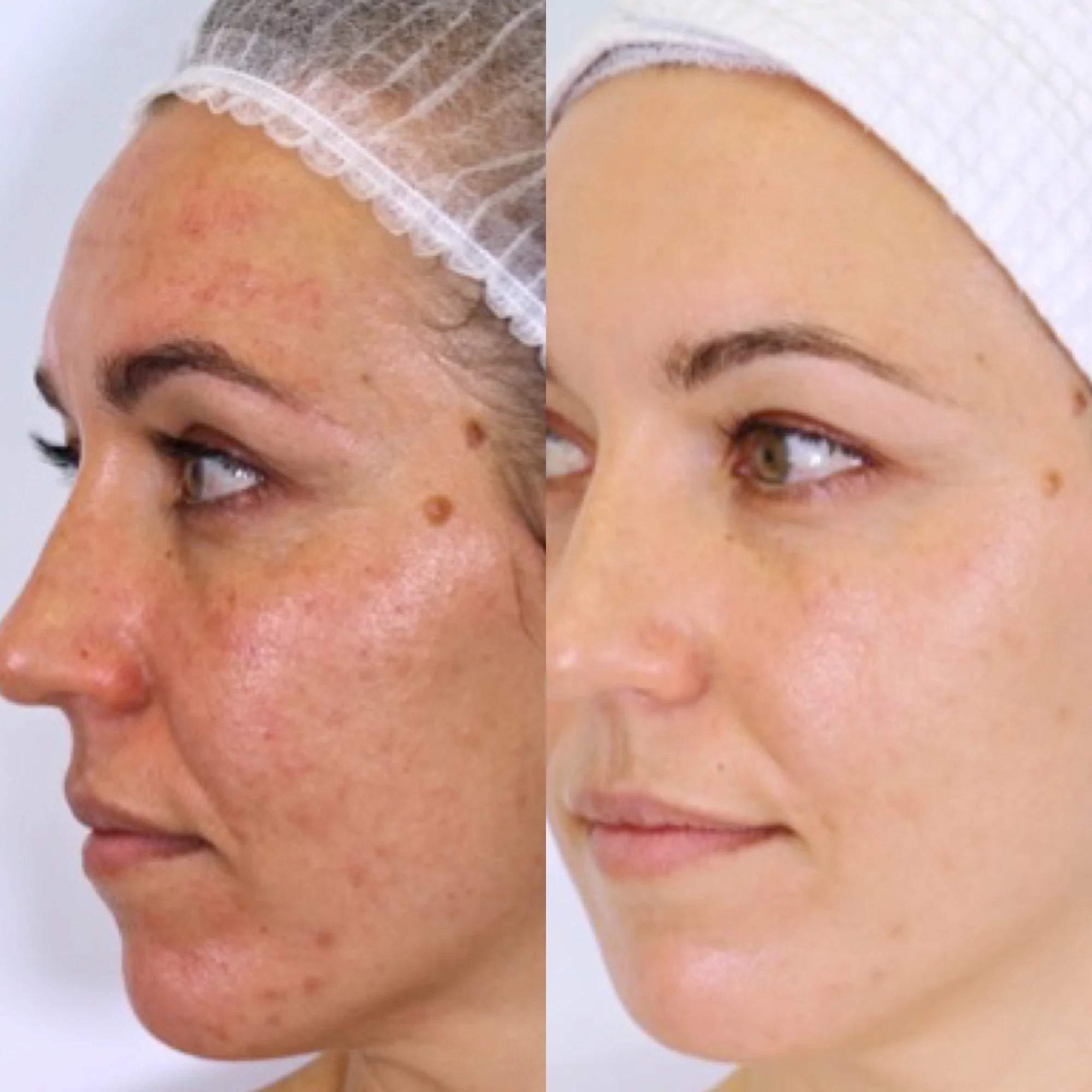 Before and after comparison of a woman's face with acne treatment.