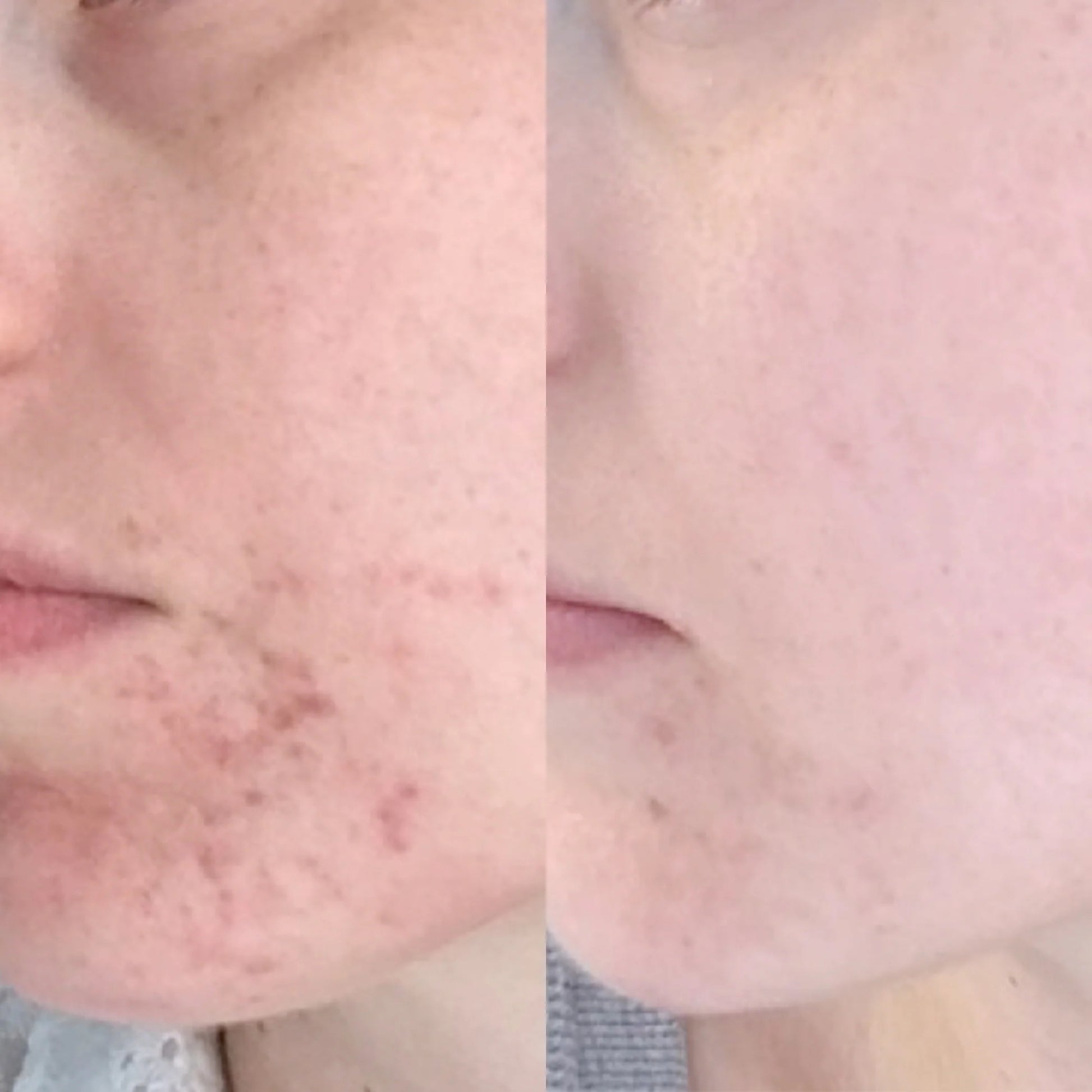 Before and after comparison of a person's face with acne treatment.