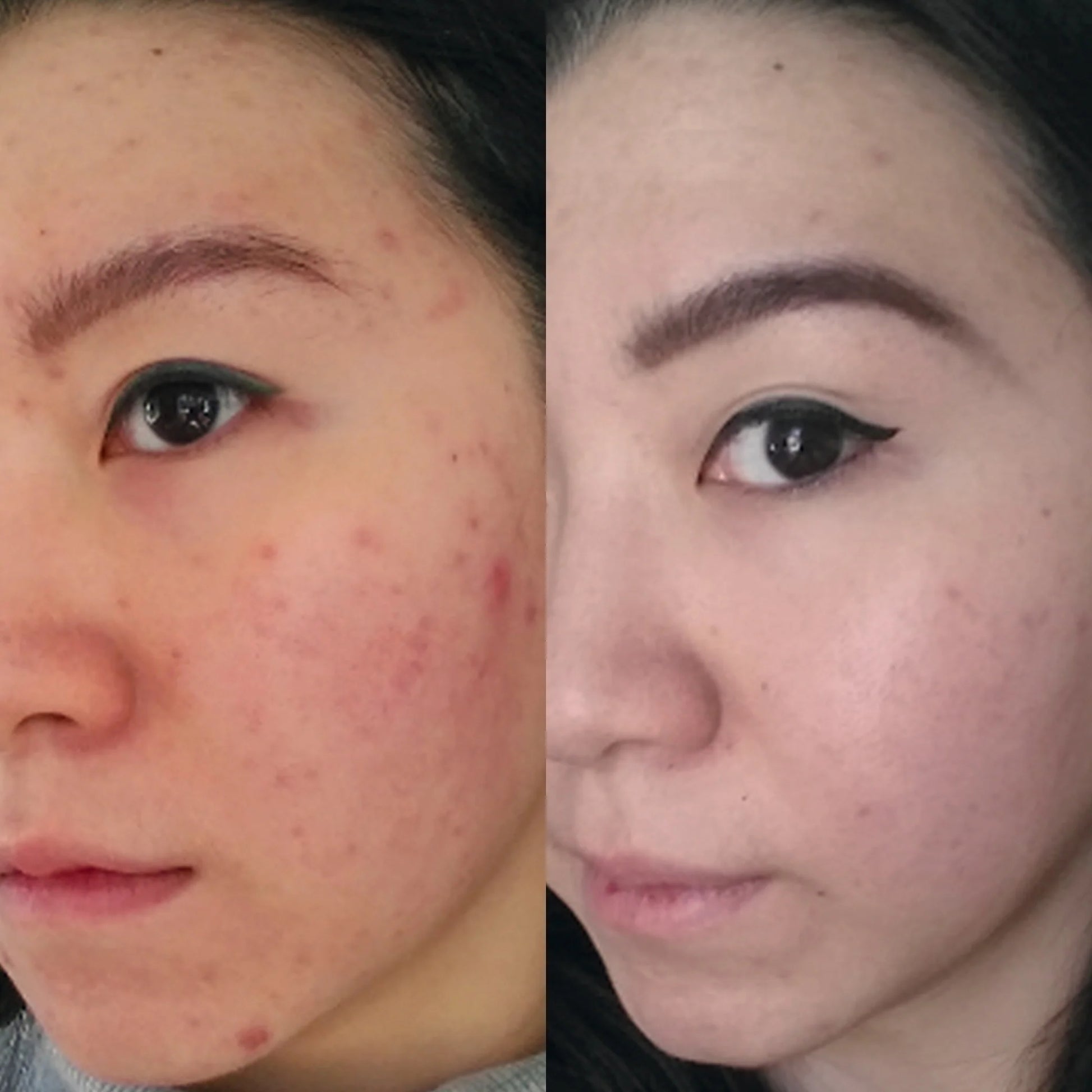 Before and after comparison of a person's face with visible skin improvement.